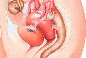 Endometriosis y embarazo